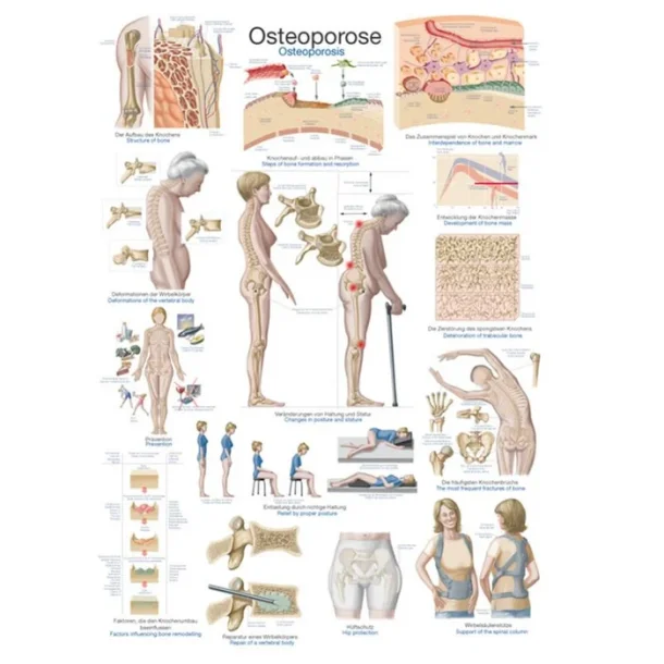 OSTEPOROSE PLAKATER